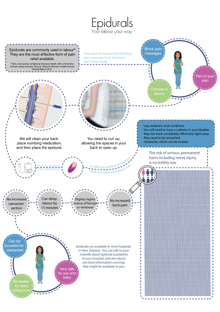 Epidural – Your Labour Your Way